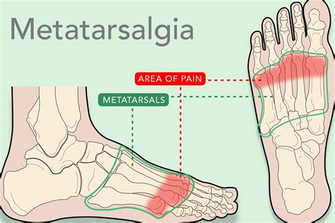 Metatarsalgia 